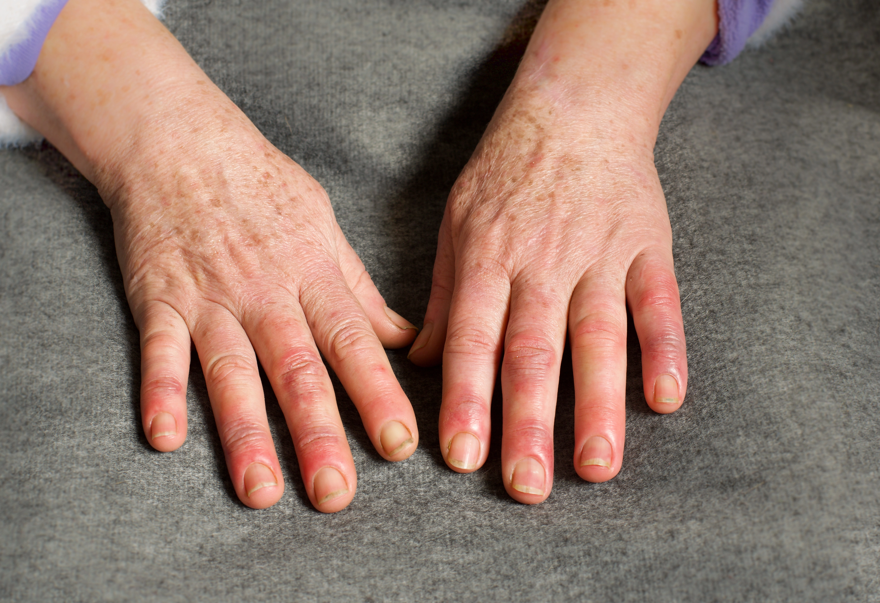 Woman showing hand changes associated with Raynaud’s phenomenon.