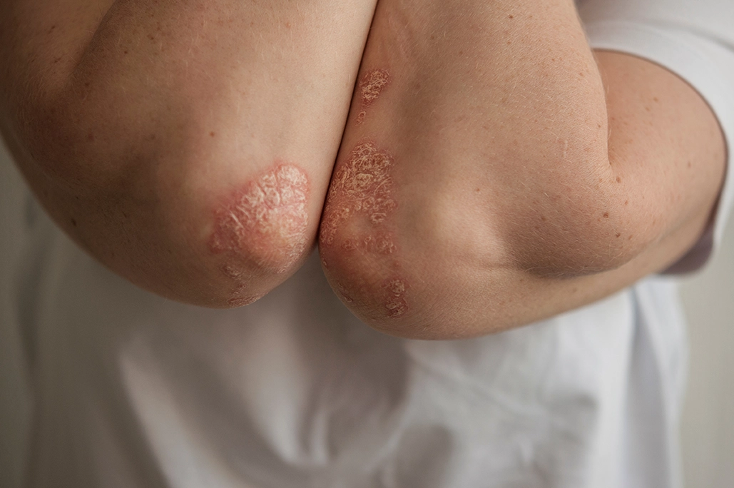 Acute psoriasis on the elbows.