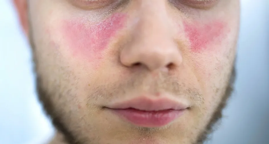 Lupus (SLE)
