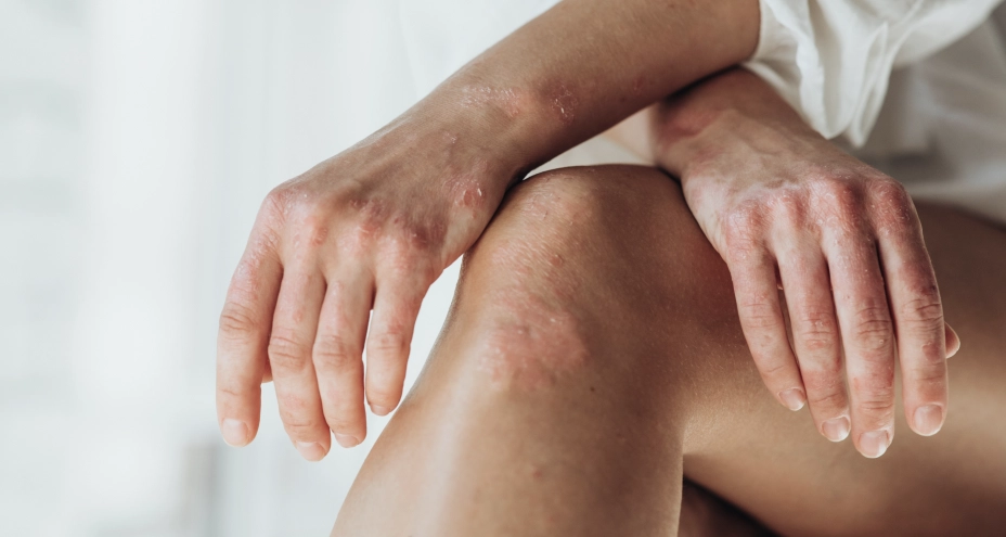 Psoriatic Arthritis (PsA)