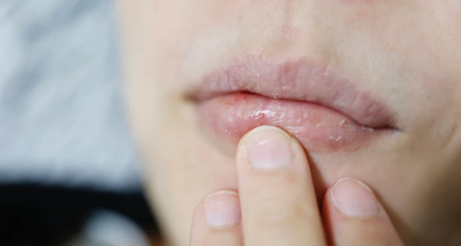 Sjögren's Syndrome