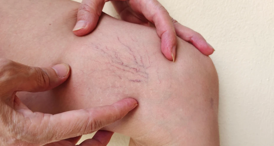 Vasculitis